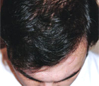 Before Hair Transplant