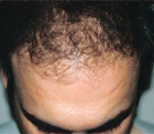 After Hair Transplant