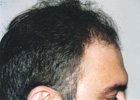 After Hair Transplant