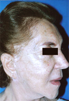 Before Hair Transplant