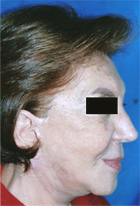 After Hair Transplant