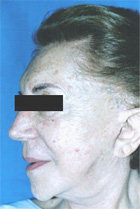 Before Hair Transplant