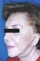 After Hair Transplant