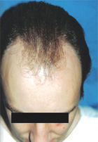 Before Hair Transplant