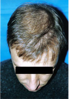 After Hair Transplant