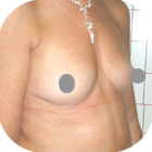 Before Breast Implant