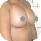 After Breast Implant