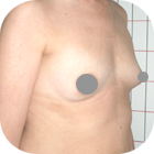 Before Breast Implant