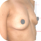 Before Breast Implant