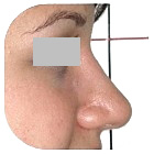 After Rhinoplasty