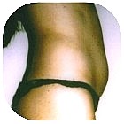 Before Liposuction