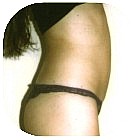 After Liposuction