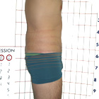 After Abdominoplasty
