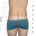 After Abdominoplasty