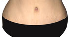 After Abdominoplasty