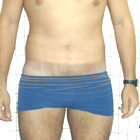 After Abdominoplasty