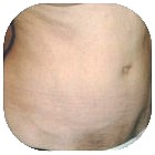 After Liposuction
