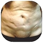 Before Liposuction