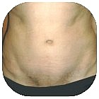 After Liposuction