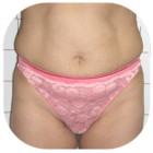 Before Liposuction