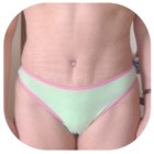 After Liposuction