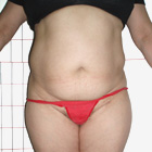 Before Abdominoplasty