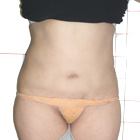 After Abdominoplasty