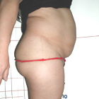Before Abdominoplasty