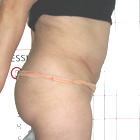 After Abdominoplasty