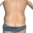 Before Abdominoplasty