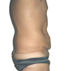 Before Abdominoplasty