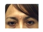 Before Eyelid Surgery