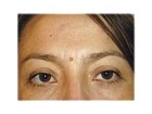 After Eyelid Surgery