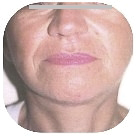 After Facelift