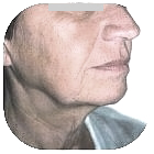 Before Facelift