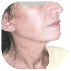 After Facelift