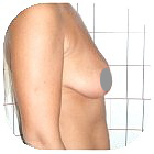 Before Breast Implant