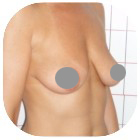 Before Breast Implant