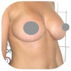 After Breast Implant