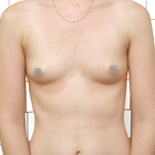 Before Breast Implant