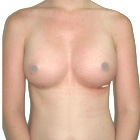After Breast Implant