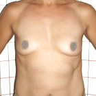 Before Breast Implant