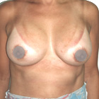 After Breast Implant