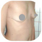 Before Breast Implant