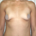 Before Breast Implant