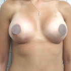 After Breast Implant
