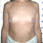 Before Breast Implant