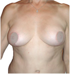 After Breast Lift