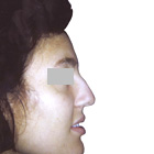 Before Lifting the tip of the nose