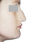 Before Lifting the tip of the nose